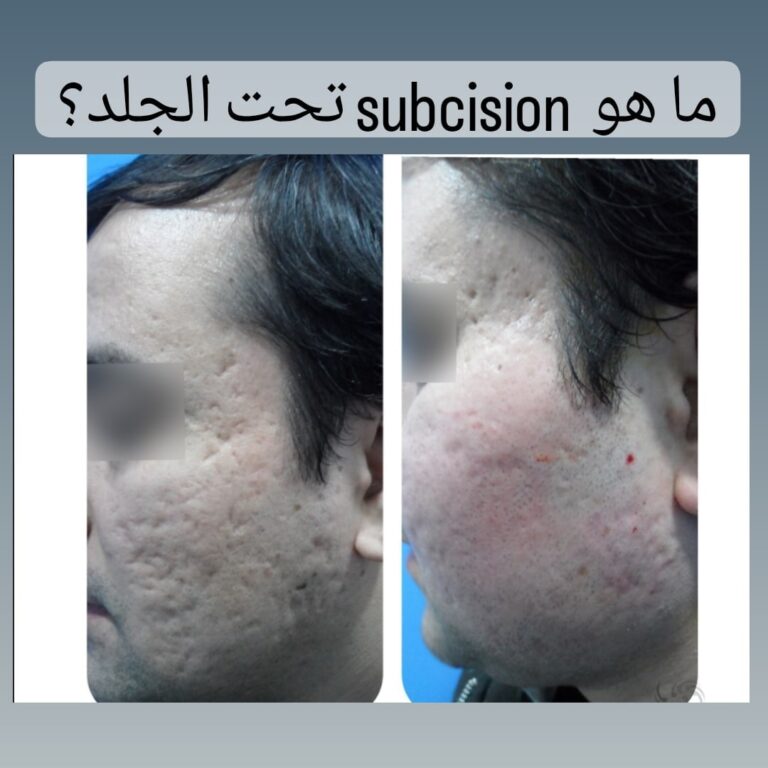 Subcision