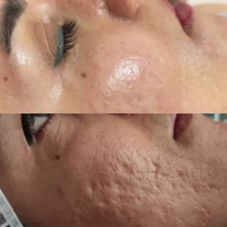 Subcision