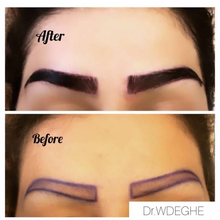 Eyebrow transplantation