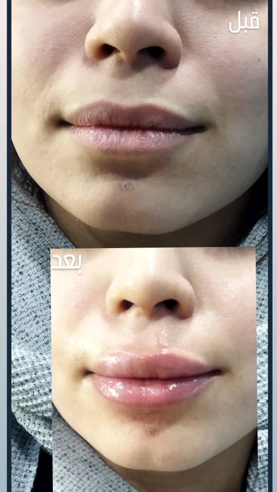 Lip gel injection