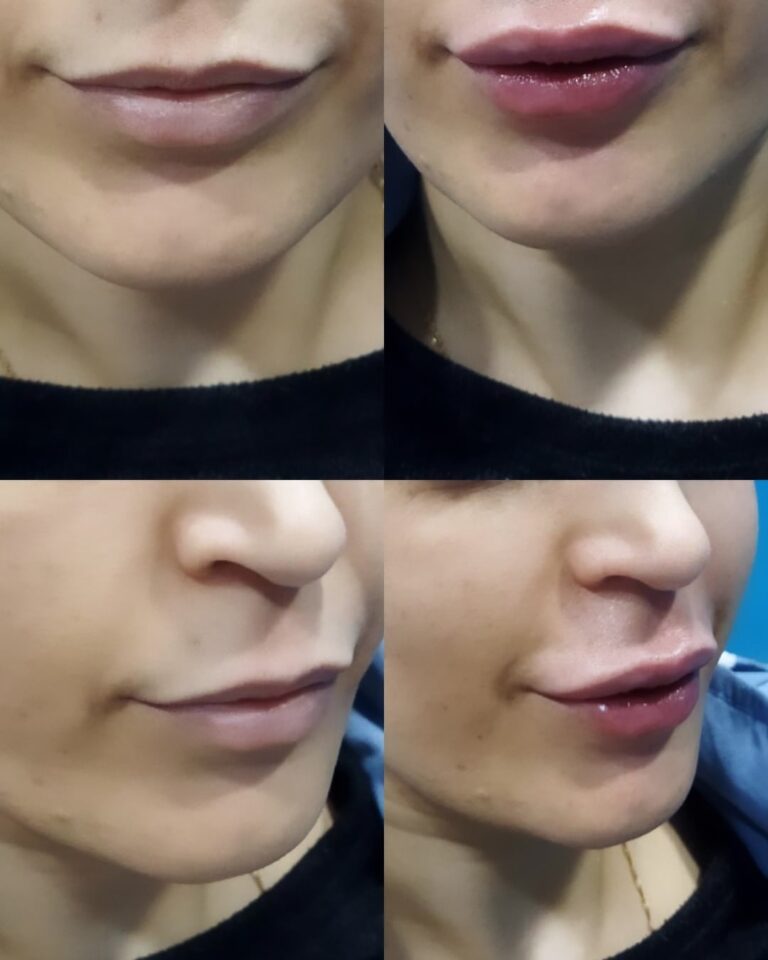 lip gel