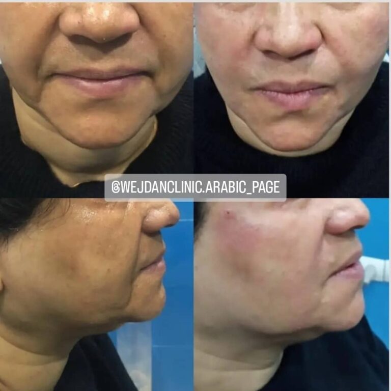 Correction of smile line and sadness with gel