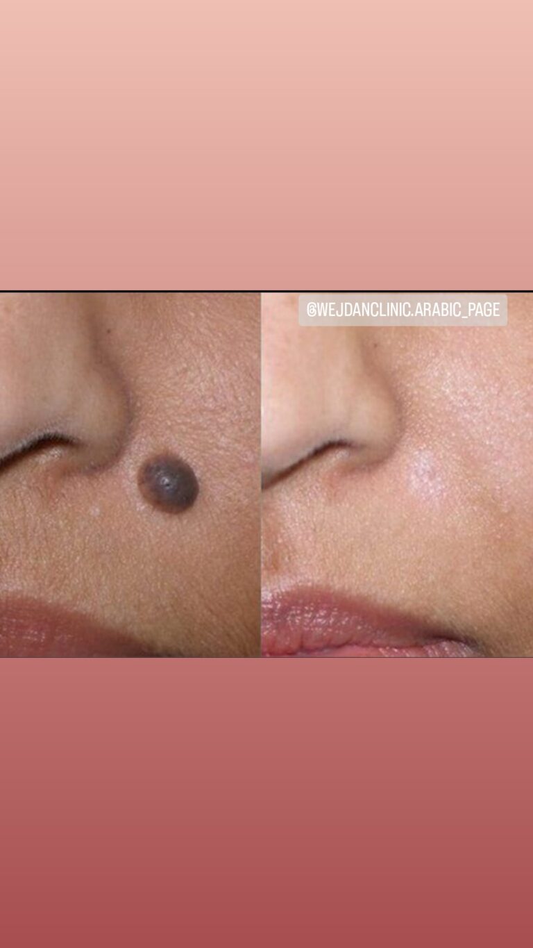 Mole removal