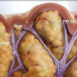 What is cellulite