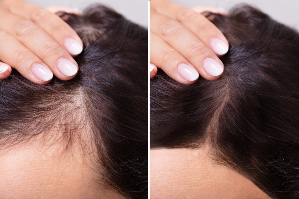 The role of mesotherapy in the treatment of hair loss