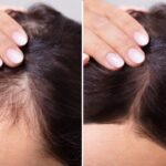 The role of mesotherapy in the treatment of hair loss